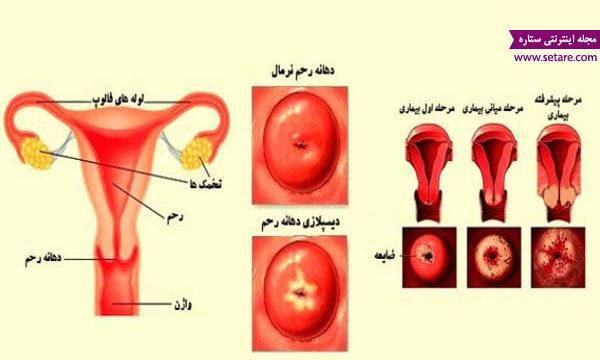 با دیسپلازی گردن رحم و درمان دیسپلازی گردن رحم آشنا شوید