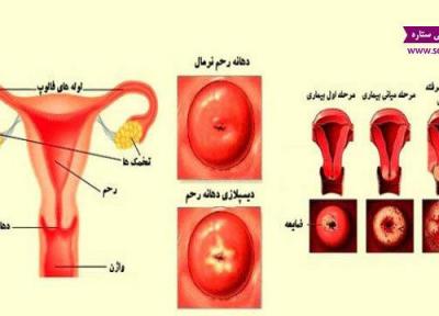 با دیسپلازی گردن رحم و درمان دیسپلازی گردن رحم آشنا شوید