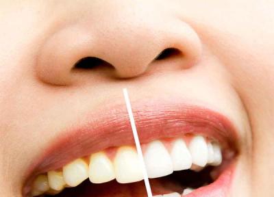 علت دندان های زرد چیست؟!
